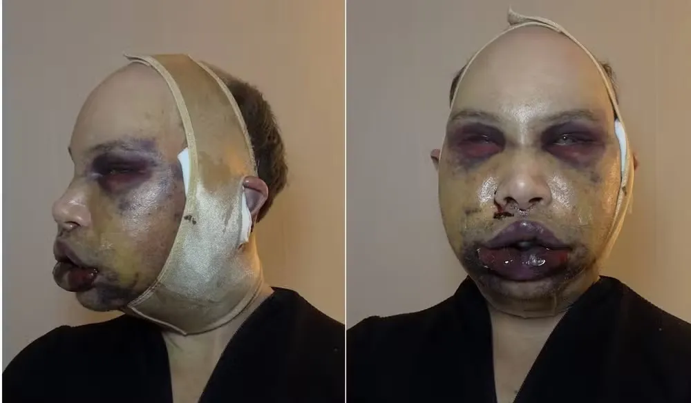 Cirurgia estética deu errado e deixou influenciador cego por horas; imagens chocam