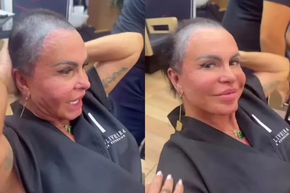 Gretchen diz que procedimento prejudicou cabelo e aumentou alopecia