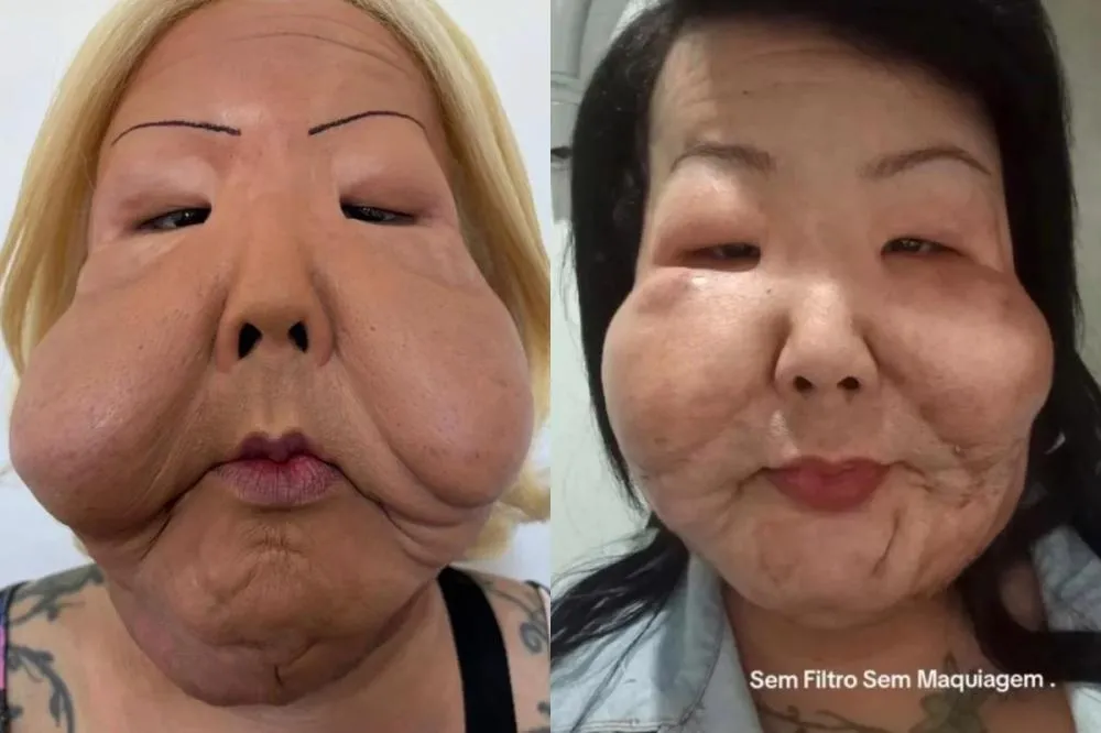 Veja como está Juju do Pix seis meses depois de cirurgia facial