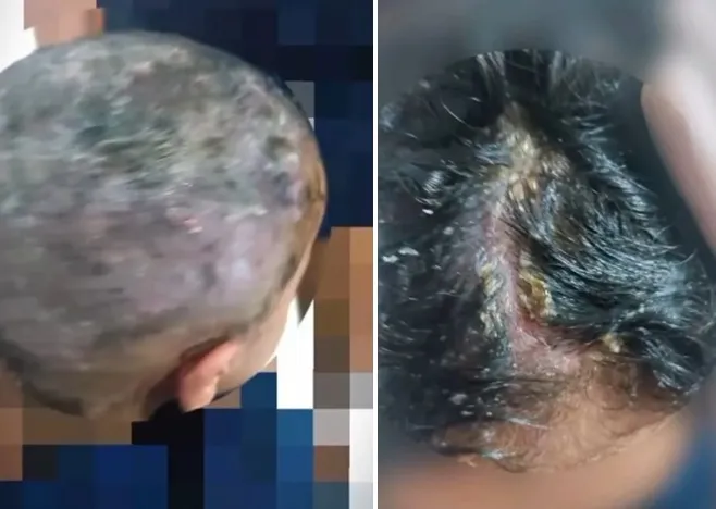 IMAGENS FORTES!! Criança fica com larvas na cabeça por 30 dias e pais são presos